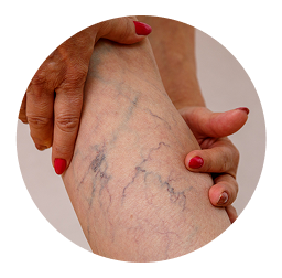 Varicose Veins